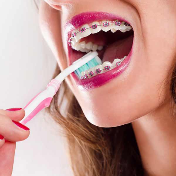 How to brush your teeth with braces